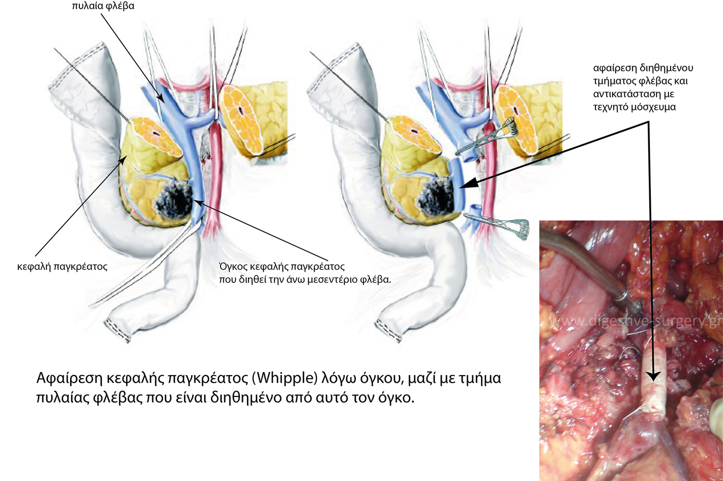 Resection and replacement of portal vein involved with cancer
