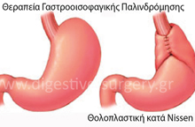 Σχηματική απεικόνιση θολοπλαστικής