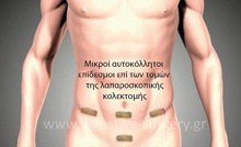 Skin incisions in laparoscopic colectomy