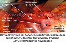 Complete lymph node dissection (skeletonization of all vessels)