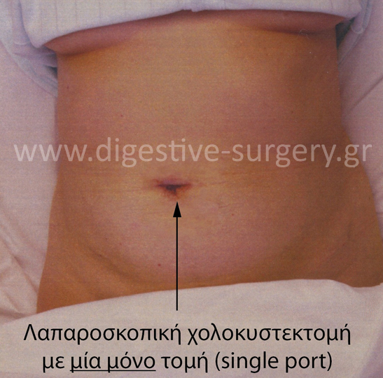 Single incision of a 30 year-old patient, 1st postoperative day