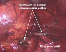 Adrenal Vein Transection