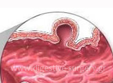 Schematic depiction of colon diverticula