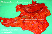 Operative specimen of radical gastrectomy