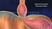 Schematic depiction of hiatal hernia