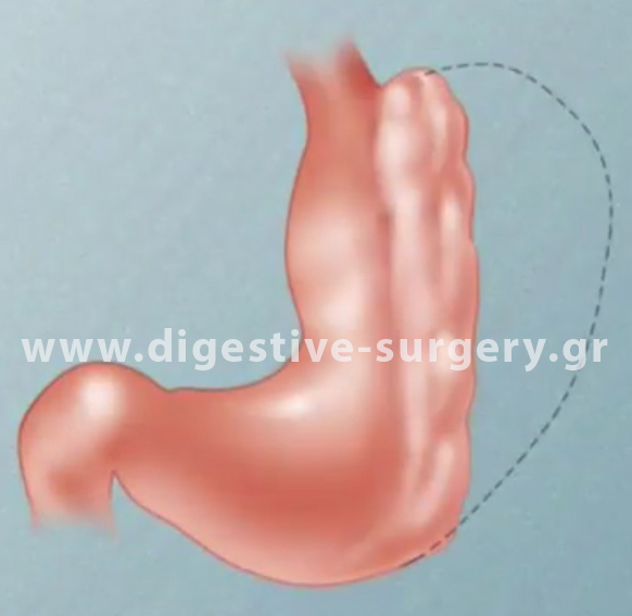 Reduced dimentions and capacity of the stomach after the placement of the internal stitches