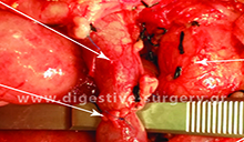 Reconstruction of the portal vein after segmental circumferential resection