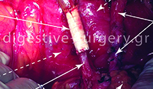 Radical resection of pancreatic cancer with extensive (total) mobilization of the superior mesenteric vessels and resection - reconstruction of the infiltrated portal vein