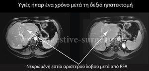 Computerized tomography after right hepatectomy