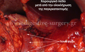 Portal vein after distal pancreatectomy