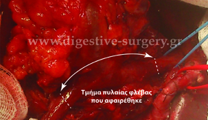 Parts of the portal and superior mesenteric vein that are to be resected