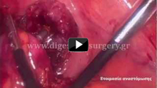 Laparoscopic colectomy  (resection of the rectum)
