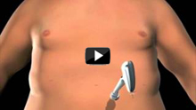 Laparoscopic placement of a gastric band