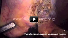Single-incision laparoscopic cholecystectomy (Single Port) 