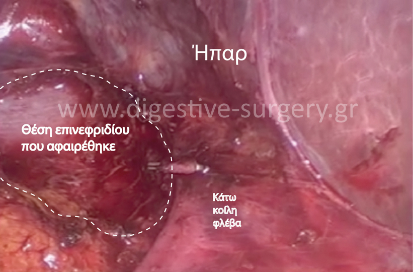 Location of the adrenal gland removed