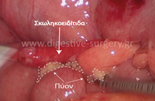 Laparoscopic removal of the appendix