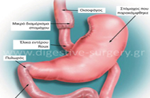 Schematic depiction of gastric bypass