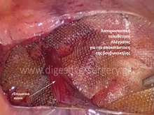 Laparoscopic mesh placement for inguinal hernia repair