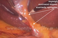 Stages of laparoscopic cholecystectomy