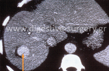 Treatment of a liver tumor with Radiofrequency Ablation