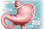 Schematic depiction of a gastric band