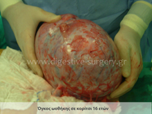 Ovarian Tumor
