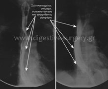 Post-operative radiograph of replaced esophagus