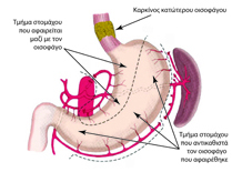 Τμήμα στομάχου που αφαιρείται και που παραμένει κατά την οισοφαγεκτομή
