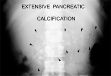 Calcifications in chronic pancreatitis