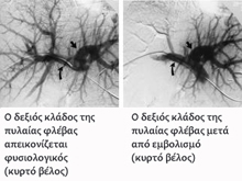 Selective embolization of the right portal vein