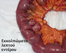 Small bowel diverticula