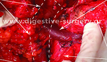 Extensive infiltration of the superior mesenteric - portal vein by pancreatic cancer: depiction of the vein segment to be resected