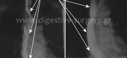 Gastric tube in replacement of the resected esophagus