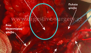 Parts of the portal and superior mesenteric vein infiltrated by pancreatic cancer