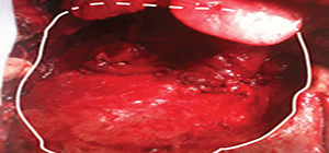Τα ανατομικά όρια του όγκου (πνεύμονας, καρδιά, ήπαρ) όπως αναδεικνύονται απελευθερωμένα μετά την αφαίρεσή του