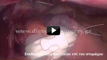 Gastric band